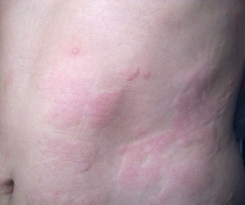 Netelroos (urticaria) · Gezondheid en wetenschap